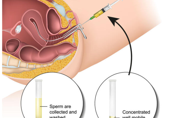 inseminazione intrauterina