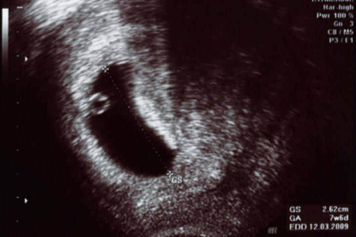 Battito cardiaco fetale - Periodo Fertile