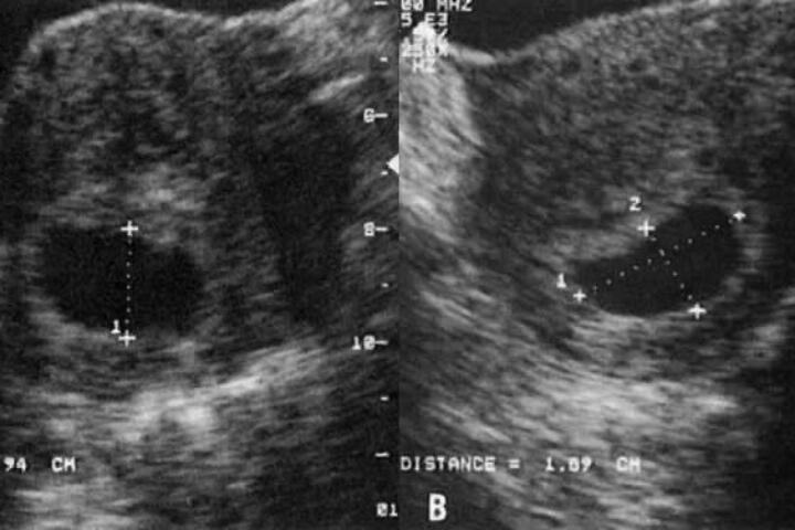 Misurazione della camera gestazionale all'ecografia