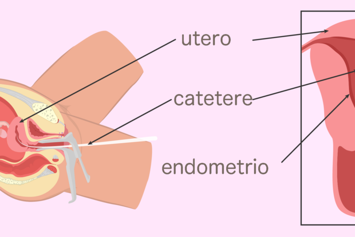 scratch endometrio