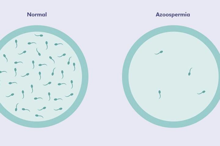azoospermia vs normale