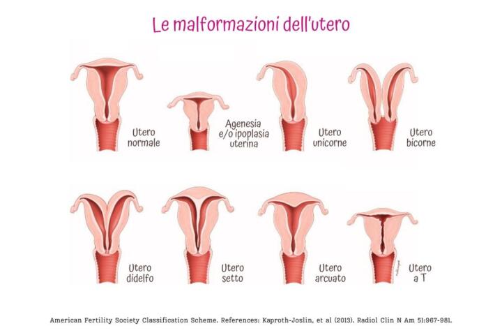 Malformazioni dell'utero: arcuato, unicorne, bicorne, setto, didelfo, a T, e agenesia/ipoplasia uterina.