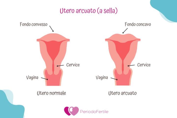 Immagine utero normale e utero arcuato (a sella)
