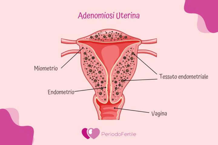 Immagine che illustra cos'è l'adenomiosi uterina