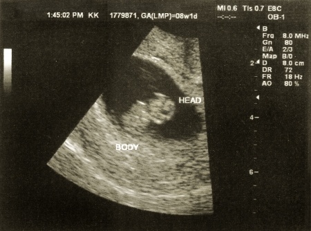 ecografia ostetrica di un feto ad 8 settimane di gravidanza