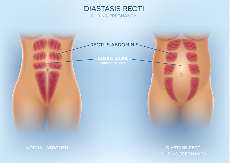 Diastasi addominale post parto: immagine