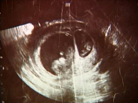 Superfetazione: immagine ecografica di due feti in diverse epoche gestazionali