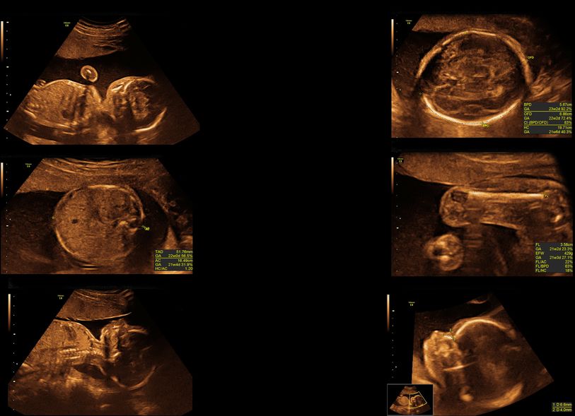 Immagini del bambino all'ecografia morfologica