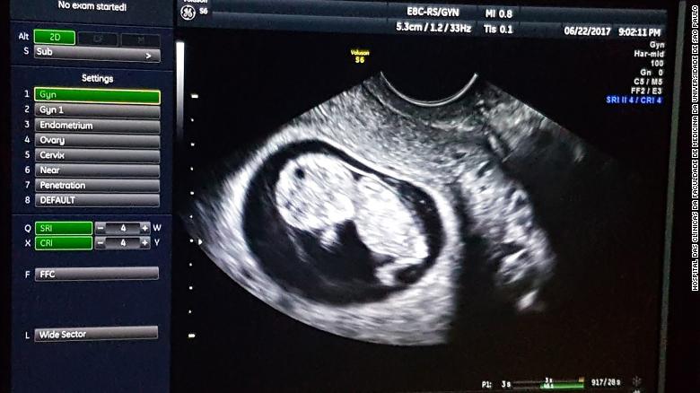 ecografia feto da trapianto di utero