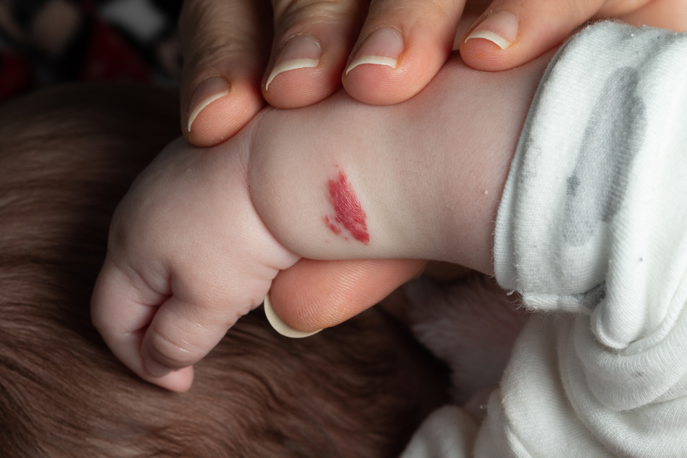 Neonato con piccolo emangioma infantile rosso vivo sul braccio.