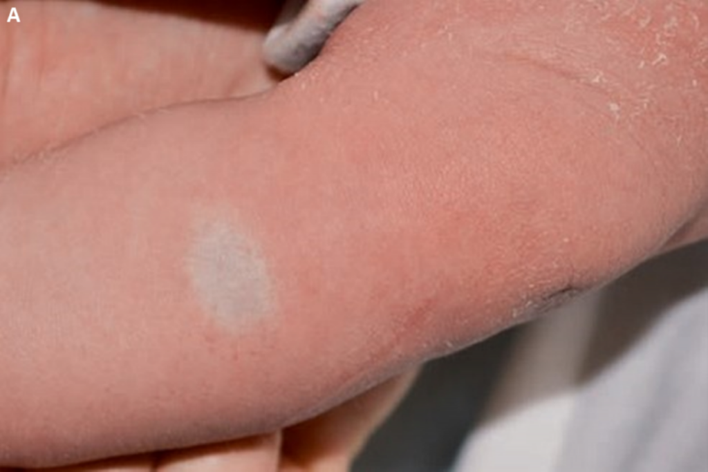 Macchia pallida sulla pelle del neonato che rappresenta un precursore dell'emangioma infantile