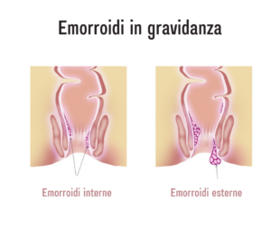 Emorroidi in gravidanza: differenza tra emorroidi interne ed esterne