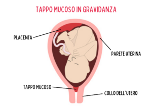 Immagine schematica dell'utero e del tappo mucoso in gravidanza