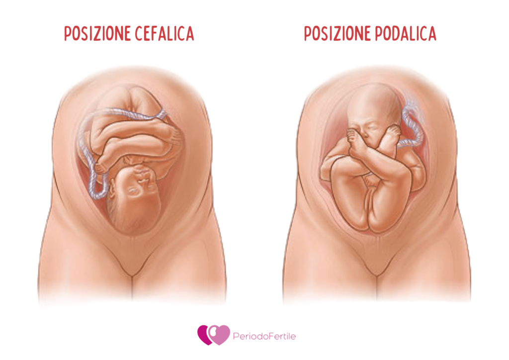 Immagine di feto podalico e feto cefalico