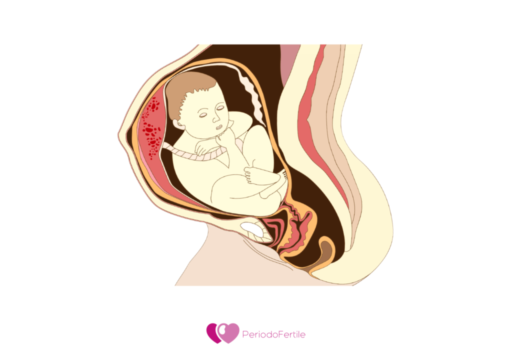 Immagine di feto podalico con presentazione podalica incompleta