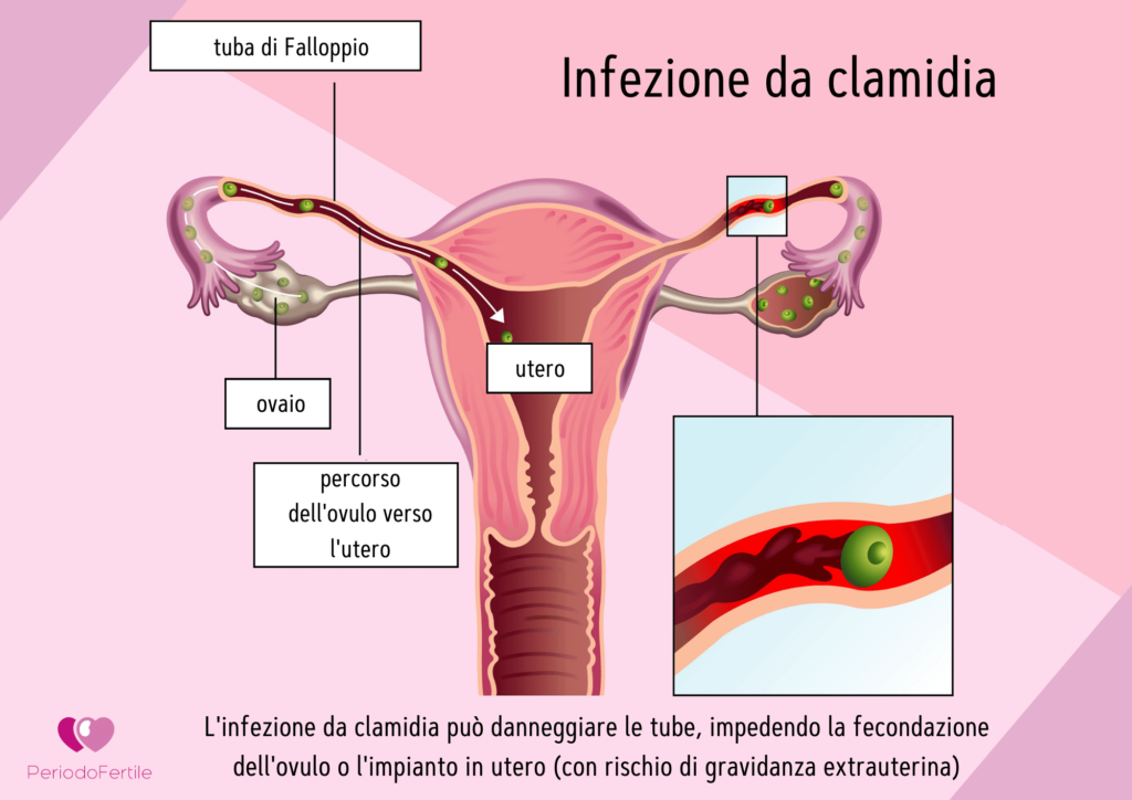 Immagine che spiega il rapporto tra clamidia e infertilità