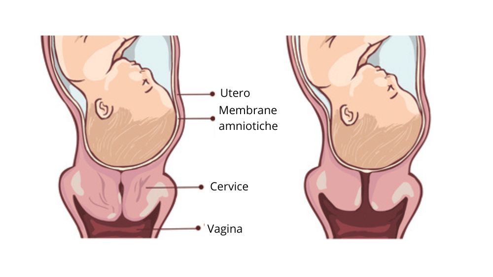 Dilatazione parto immagine 7: fase prodromica