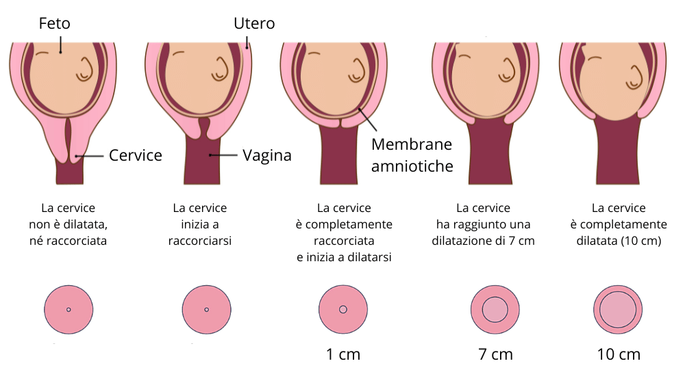 Dilatazione parto immagine 6: fasi di dilatazione della cervice durante il parto