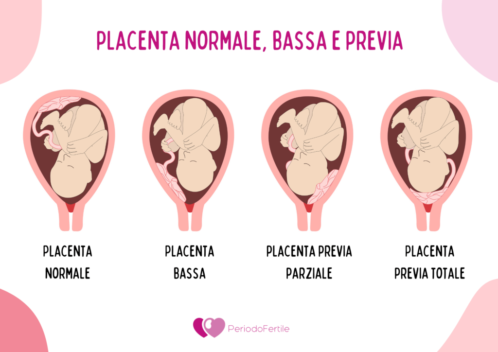 Immagine che spiega la differenza tra placenta bassa, normale e previa.