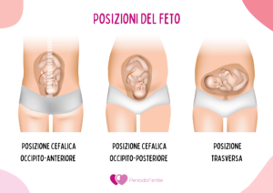 Posizioni del feto nell'utero: cefalica occipito-anteriore, cefalica occipito-posteriore e trasversa.