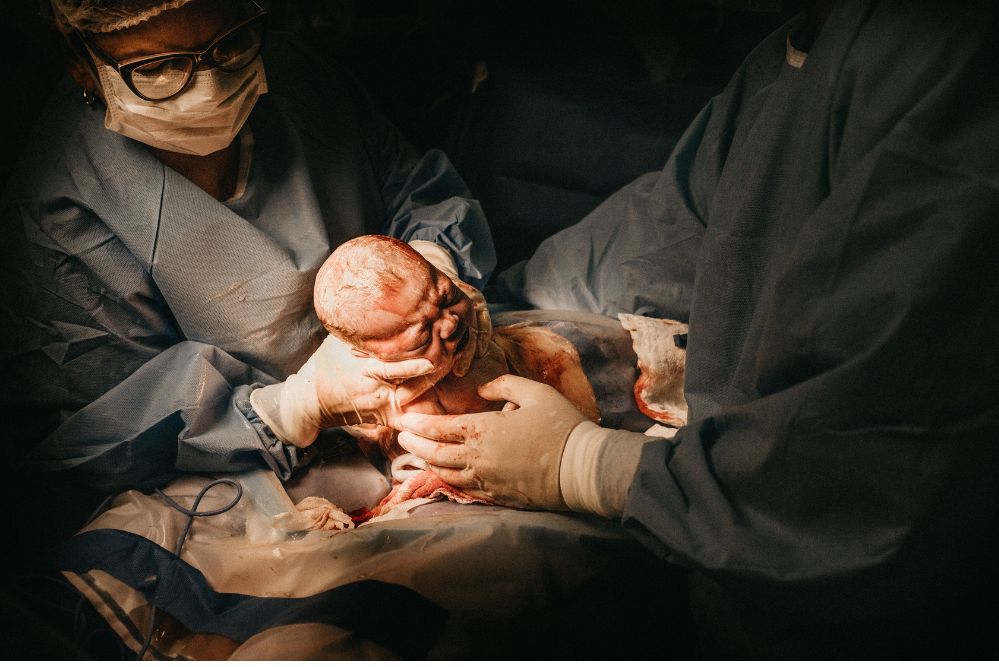 Bambino estratto durante cesareo