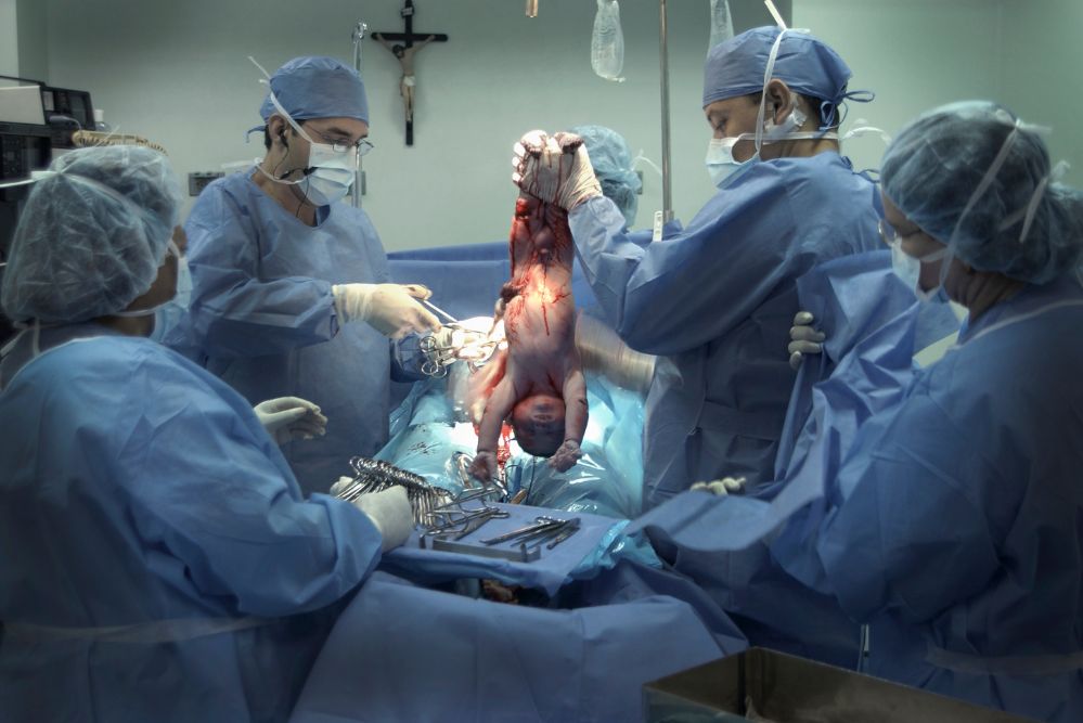 Neonato appena nato da parto cesareo
