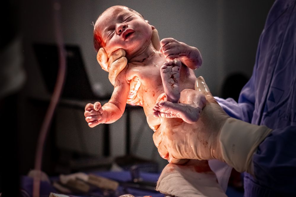 Neonato appena nato dopo taglio cesareo