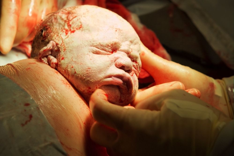 Testolina neonato durante cesareo