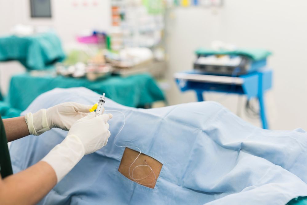 anestesia epidurale prima del cesareo